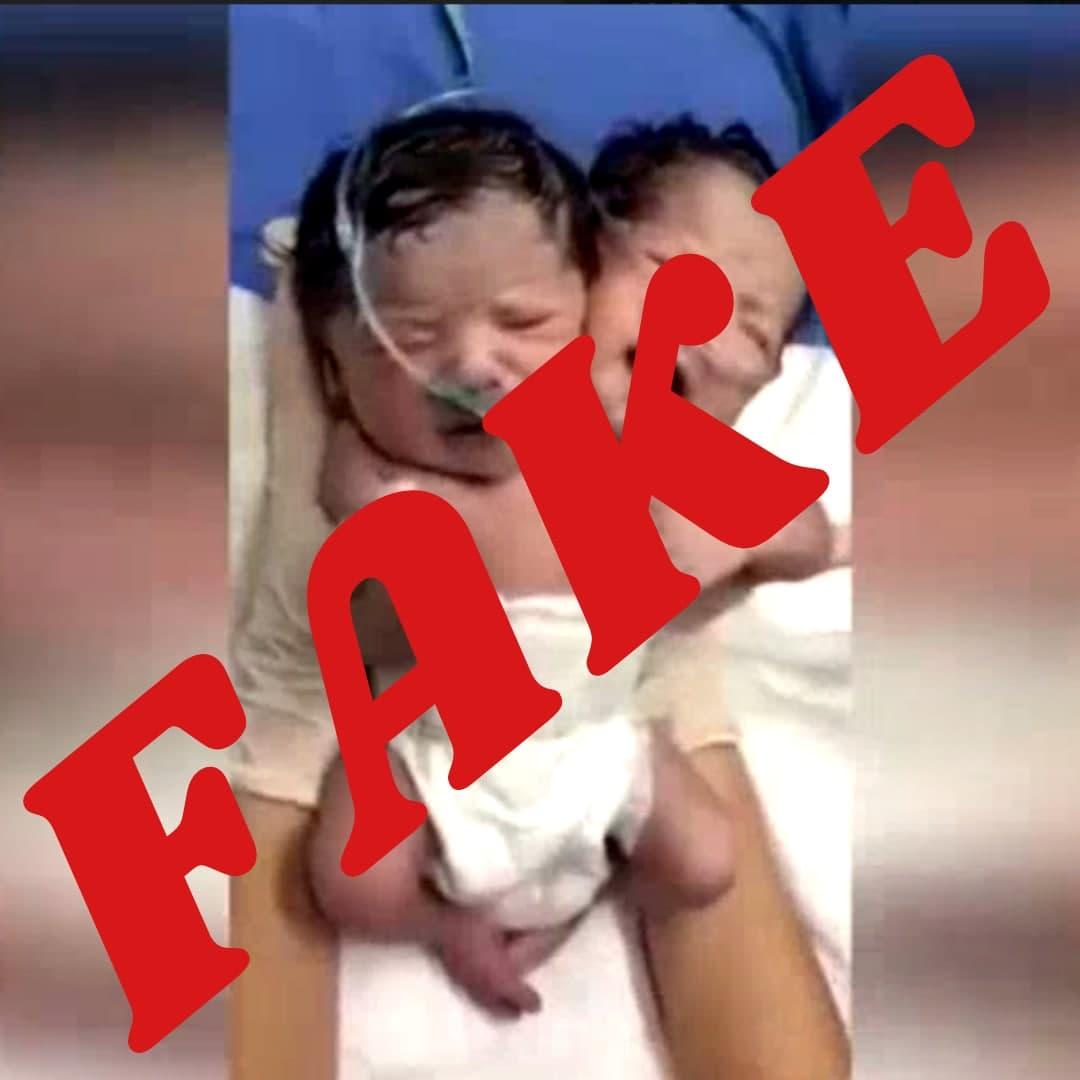 В Минздраве опровергли сообщения о рождении сиамских близнецов в Узбекистане