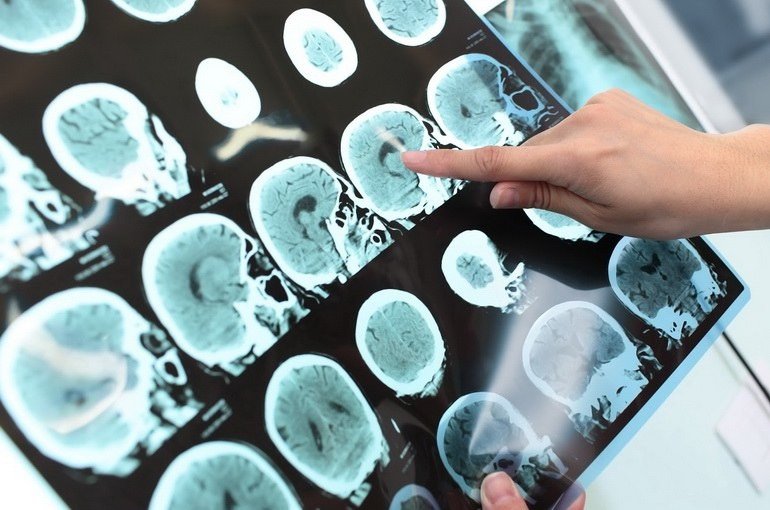 Разработан препарат от болезни Альцгеймера