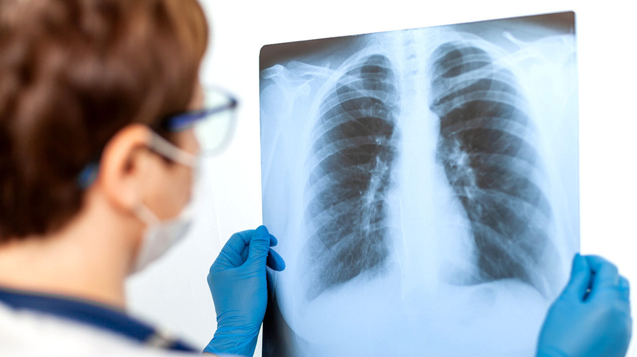 За прошедшие сутки в Узбекистане было выявлено менее 50 случаев заражения пневмонией — новая статистика