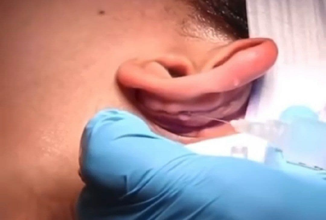 Отопластика: как проходит операция по коррекции лопоухости – видео