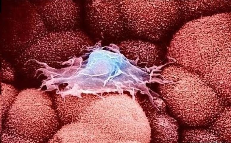Названы первые симптомы раковой опухоли