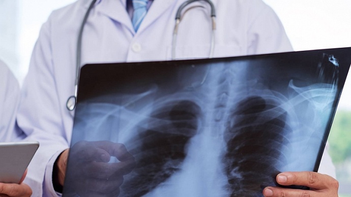 В Узбекистане в сутки от пневмонии выздоравливают больше пациентов, чем инфицируются — статистика