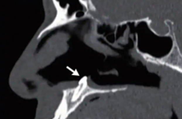 Росший в носу у мужчины зуб долгие годы мешал пациенту дышать — подробности