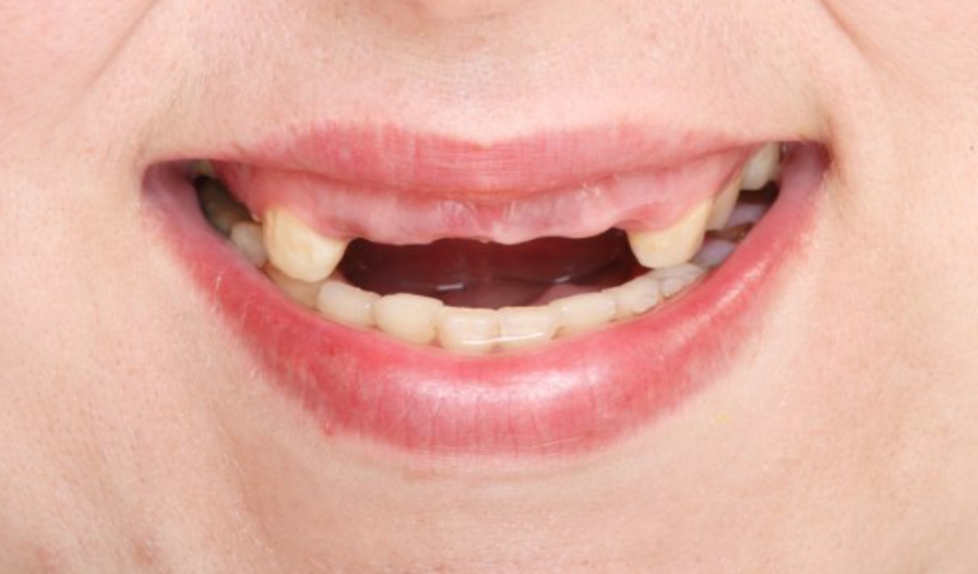 При диабете выпадают зубы — как еще выявить признаки диабета?