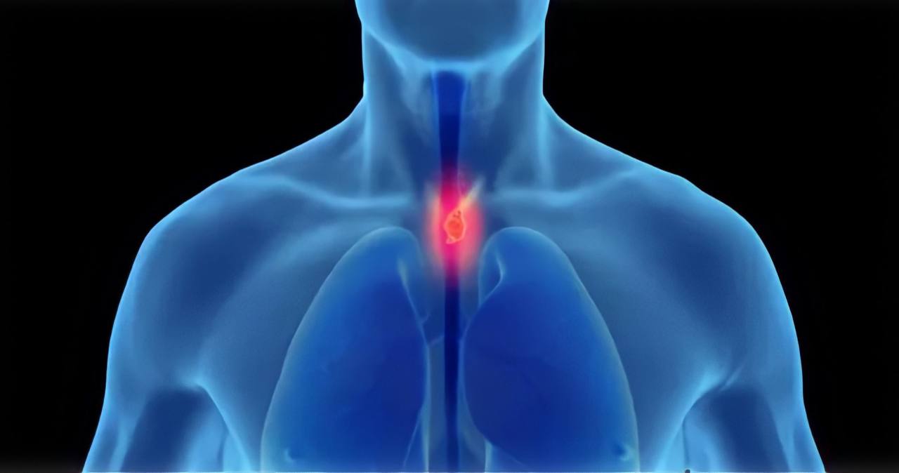 Ученые назвали четыре неочевидных симптома рака пищевода