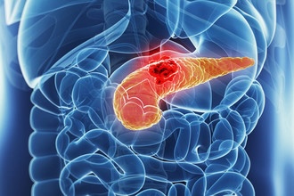 Раскрыт новый метод лечения поджелудочной железы у больных раком