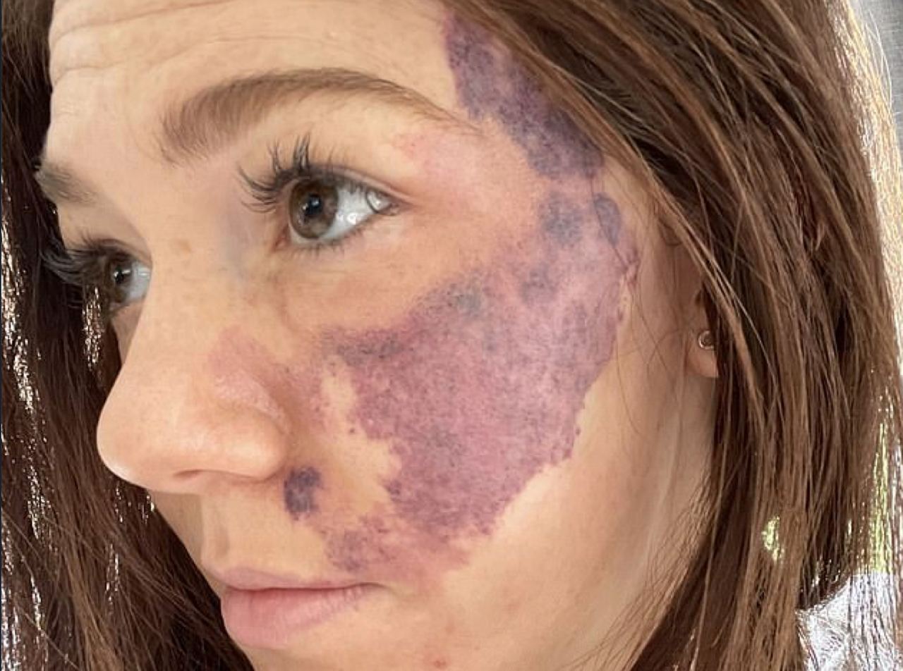 Девушка пять лет скрывала от жениха родимое пятно на пол-лица, замазывая его «тоналкой»