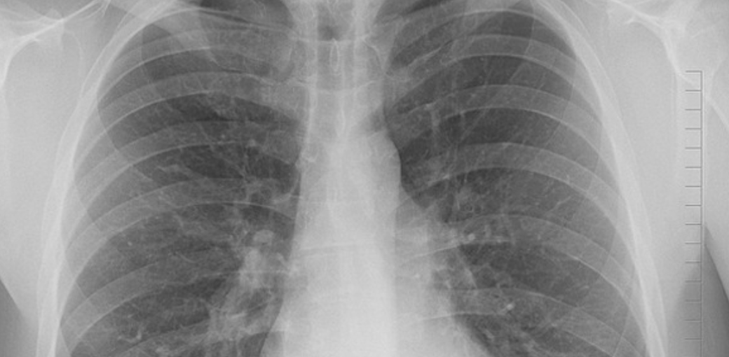 В Узбекистане еще один человек умер от пневмонии — статистика