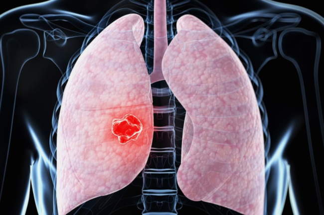 В Узбекистане практически не были выявлены случаи заражения пневмонией за прошедшие сутки — статистика