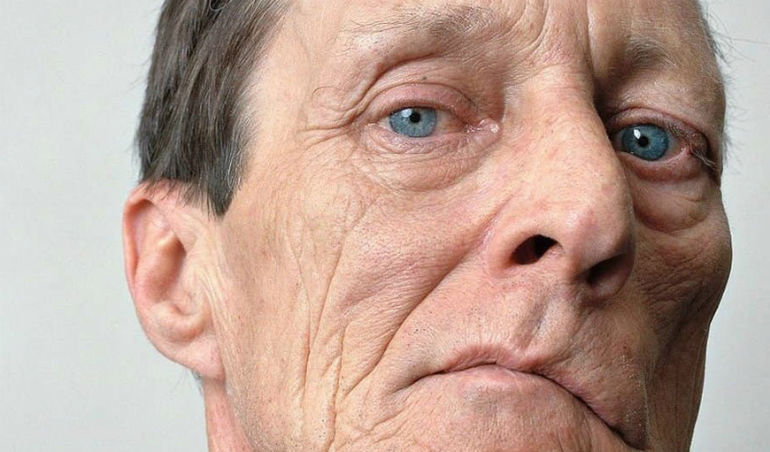  Как снизить риск инсульта?