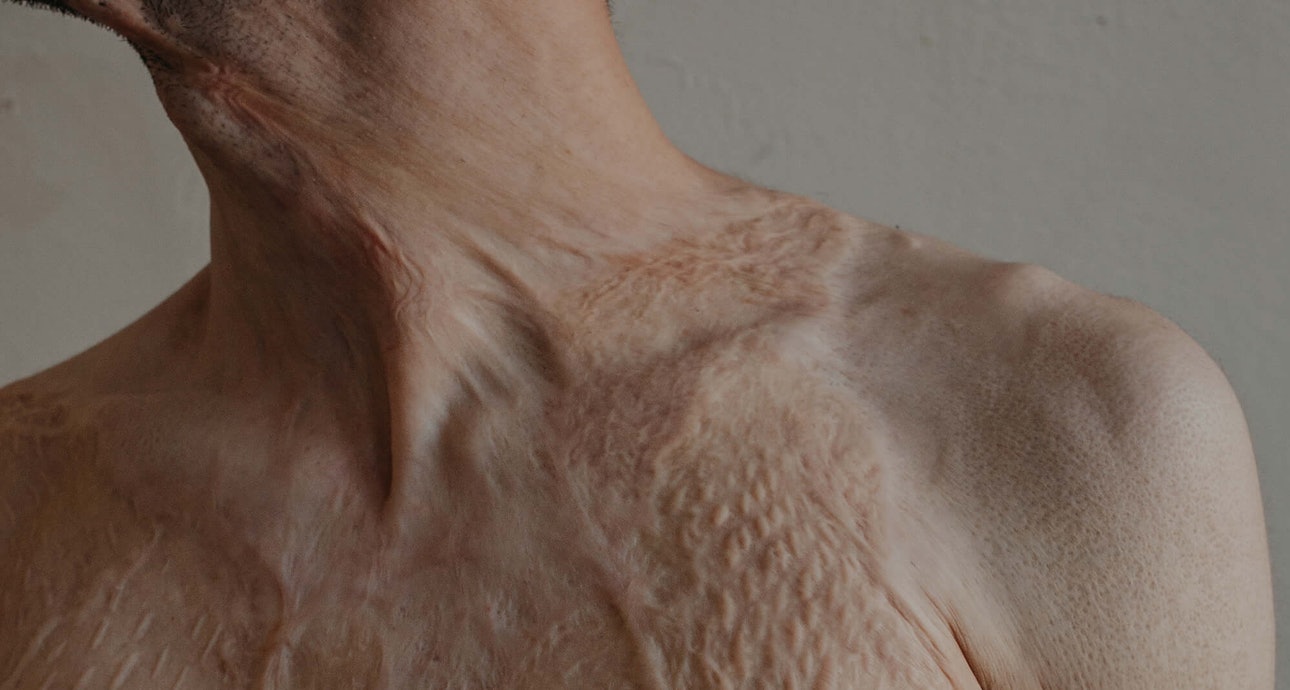 Учёные обнаружили препарат, заживляющий раны без шрамов