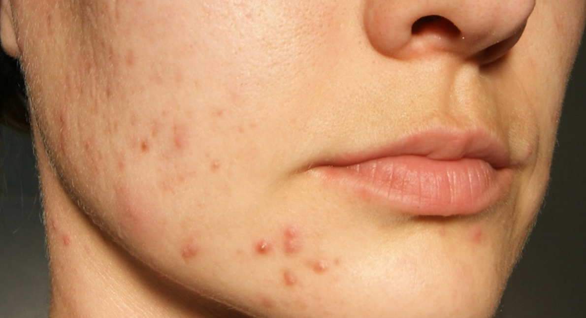 Какие продукты вредны для кожи?