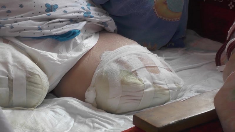 Девятнадцатилетний студент лишился ног до колен после того, как съел лапшу с курицей 