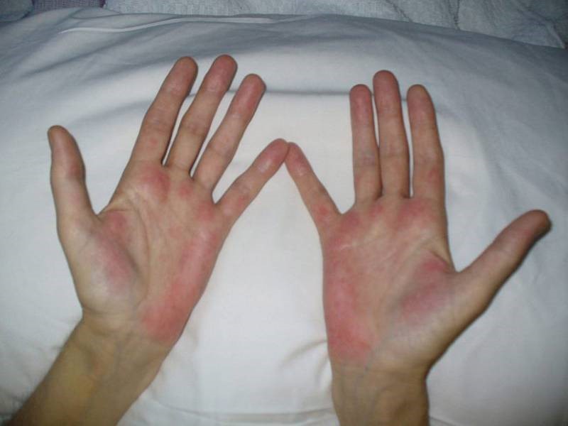 Как определить по коже, что у вас серьезная болезнь печени