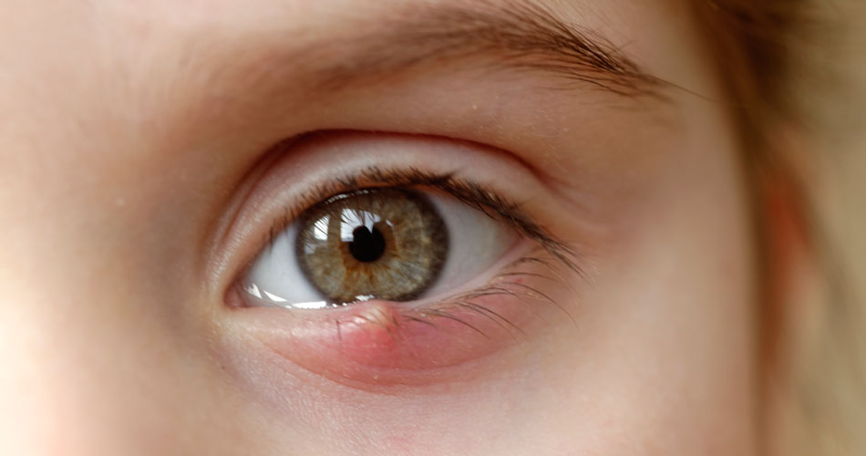 Почему появляется ячмень на глазу