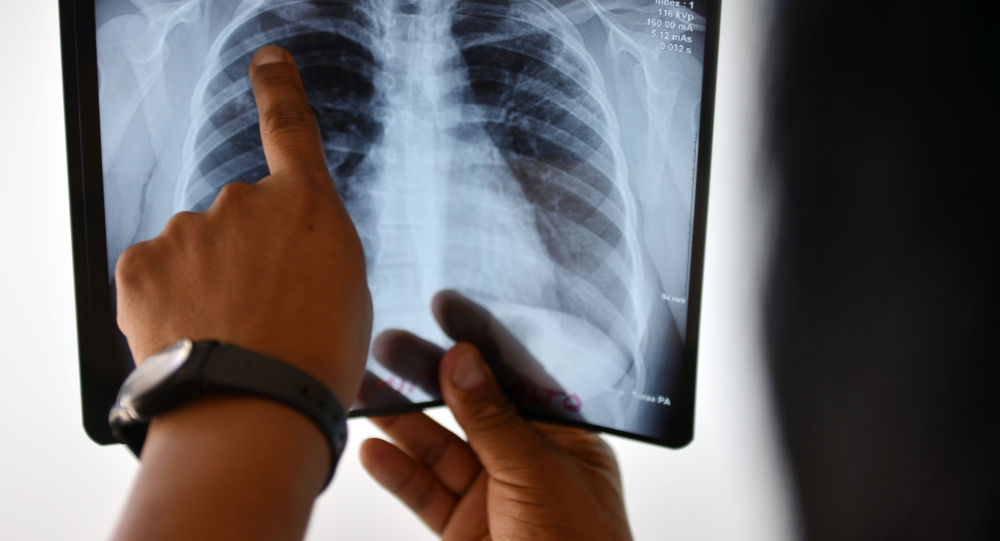 За прошедшие сутки у 59 узбекистанцев выявили пневмонию - статистика