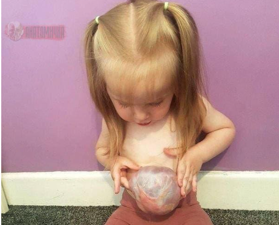 Рассказываем об одном из редких врожденных заболеваниях — гастрошизисе у детей