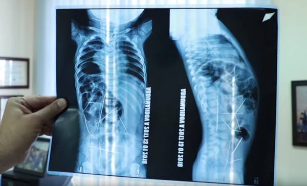 Новые подробности в истории мальчика из Ферганы с 16 иголками в теле