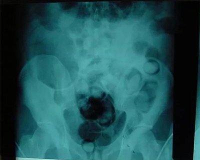 В Казахстане узбекистанец пытался провезти марихуану внутри себя, но не смог