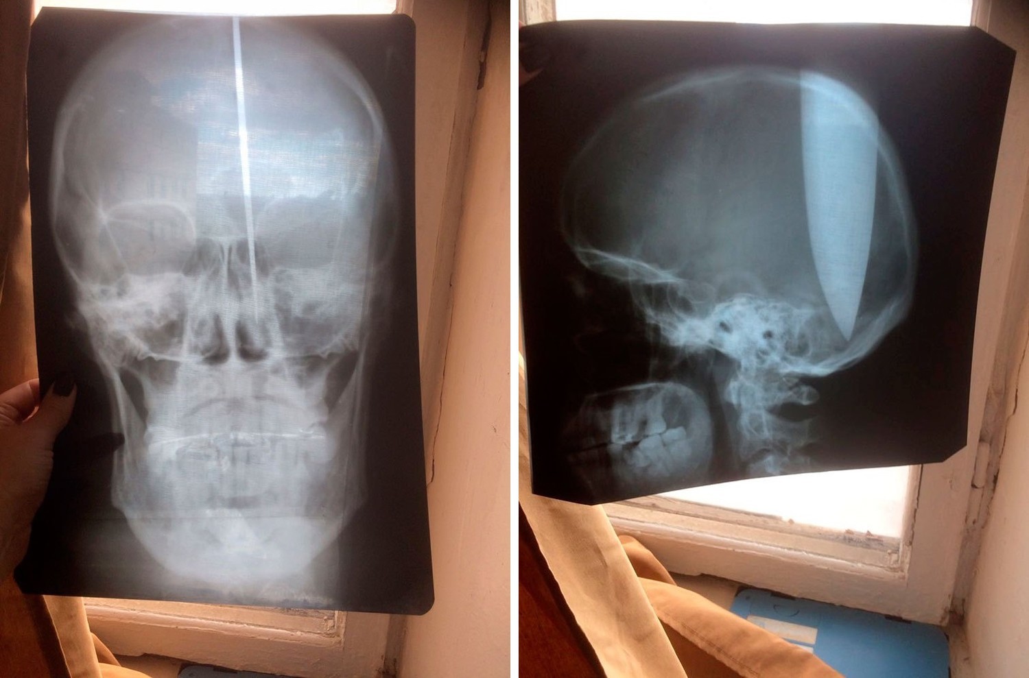 Названа возможная причина шизофрении