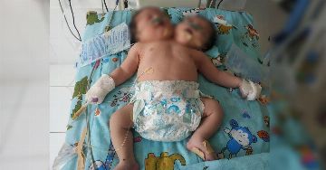 Сиамские близнецы в Самарканде скончались 