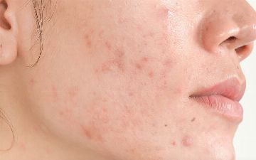 Эксперты рассказали всю правду об акне