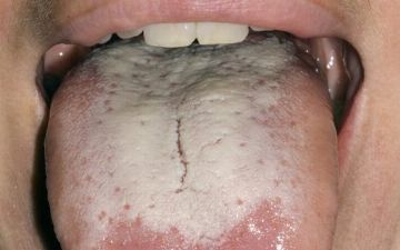 Узбекский эндокринолог рассказала, как определить болезнь ЖКТ по языку