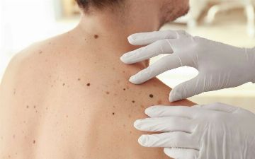 На какие родинки нужно обращать внимание и опасна ли травма родинки