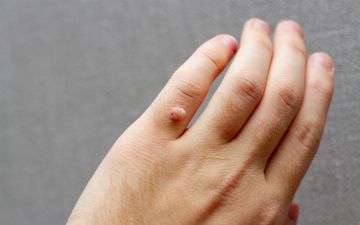 Стало известно, заразны ли бородавки