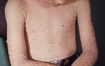 Люди-рыбки. Что такое ихтиоз?