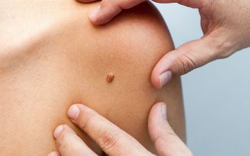 Папилломы: признак того, что вас заживо съедают изнутри