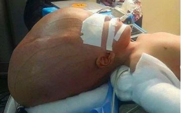 Мегамозг: большая голова — признак врожденной гидроцефалии