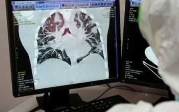 За прошедшие сутки в Узбекистане 4 человека умерли от пневмонии — статистика