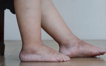 В чем опасность отека ног — мнение терапевта
