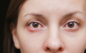 Ячмень на глазу: почему он появляется, как его лечить, а как – не стоит