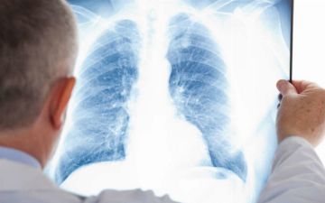 Число новых пациентов с пневмонией уменьшается каждый день — статистика