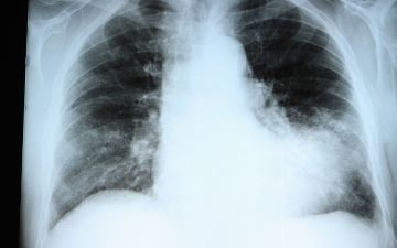 Как изменилась статистика заболевшим пневмонией за вчерашний день — статистика