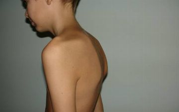 Сколиоз можно вылечить — способ есть