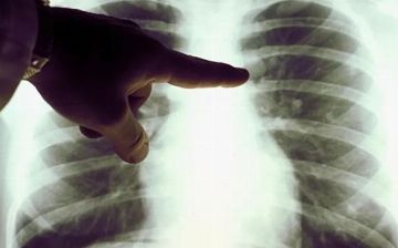 На выходных у 6 узбекистанцев выявили пневмонию 