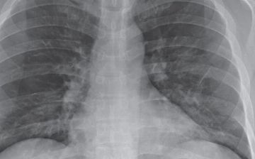 В Узбекистан вернулась пневмония — статистика