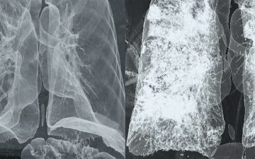 Российский врач рассказал о способе выявить пневмонию при COVID-19