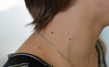 Почему нельзя травмировать родинки? Рассказал дерматолог