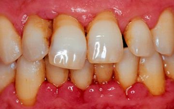 Стало понятно, зачем нужно немедленно заняться лечением десен