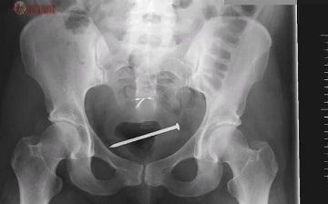 Женщина поместила себе в матку гвоздь, чтобы ее не изнасиловали