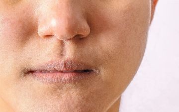 Как защитить кожу зимой — пять способов