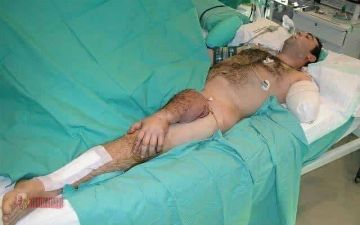 Врачи спасли оторванную руку пациента и пришили ее к ноге — фото