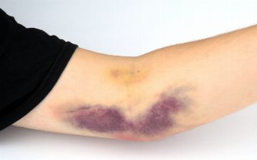 Чем опасны синяки на теле, которые появились без причины после коронавируса