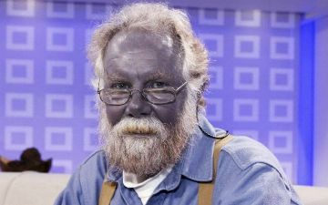 Одно из редчайших заболеваний – синдром синей кожи