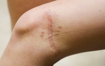 Как избавиться от шрамов и рубцов — 5 народных методов