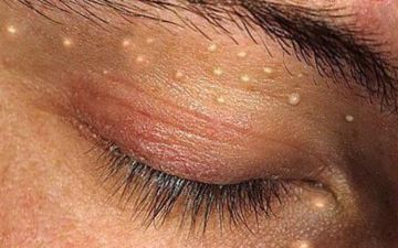 Что такое контагиозный моллюск и почему от него нужно срочно избавляться